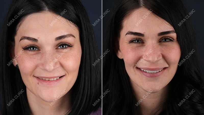 Before and After